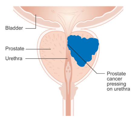 Diagram showing prostate cancer pressing on the urethra
